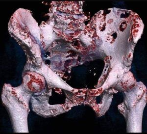 Así luce el hueso cuando el cáncer ya ha avanzado. 